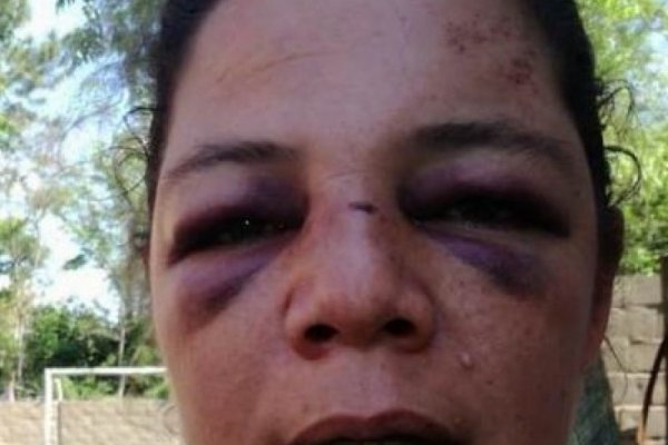 Violencia de género: Desfiguró el rostro a su concubina y escapó