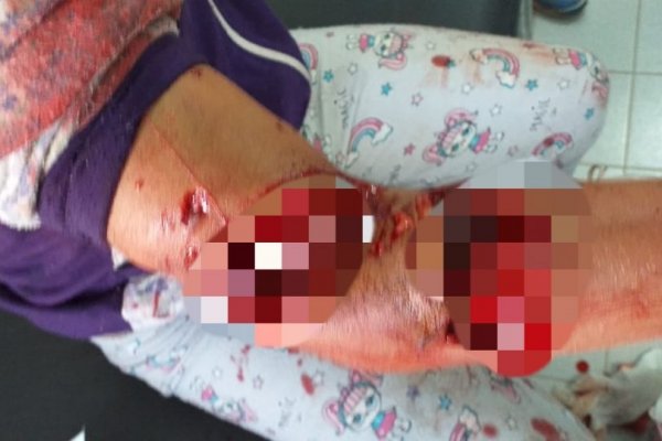 Chaco: Una menor fue atacada brutalmente por un perro de su vecina