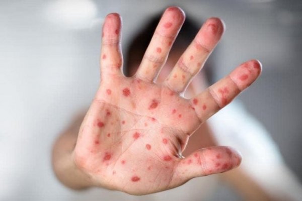 Brotes: No hay casos de sarampión en Corrientes e insisten con la vacunación