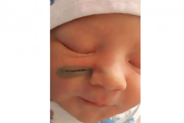 Bebé quedó con una cicatriz en la cara luego de que los cirujanos la cortaran en la cesárea