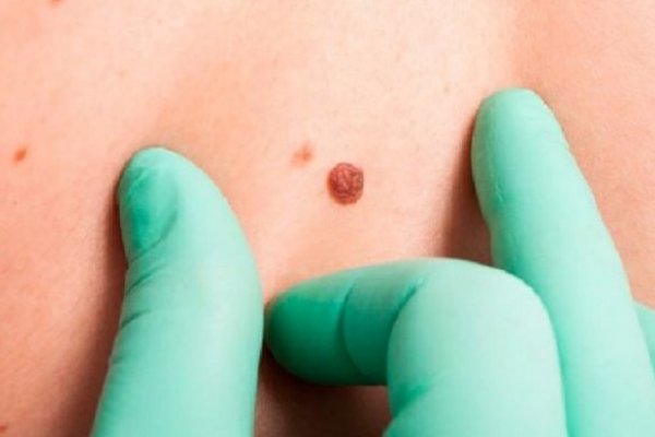 Consultas dermatológicas gratuitas para prevenir el cáncer de piel