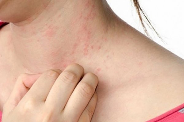 Coronavirus: las lesiones en la piel también podrían ser un síntoma