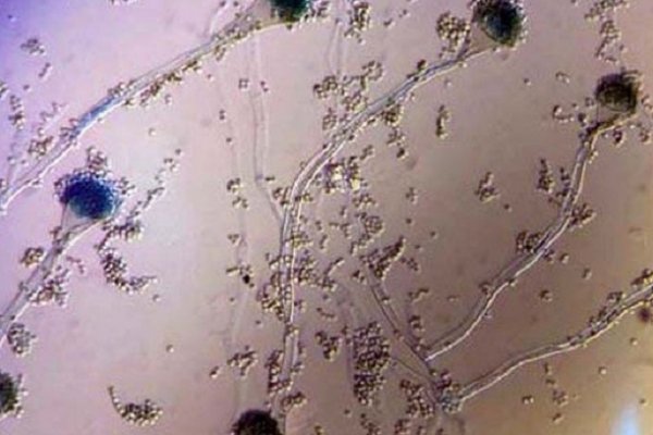 Covid: Detectan hongo que causa infección en pacientes graves