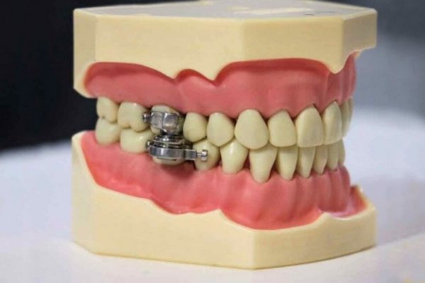 Un candado en los dientes: el nuevo dispositivo para adelgazar que desató la polémica