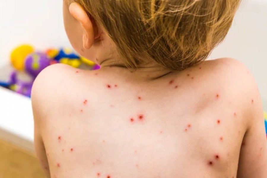 Desde mañana será obligatoria una segunda dosis de la vacuna contra la varicela en niños