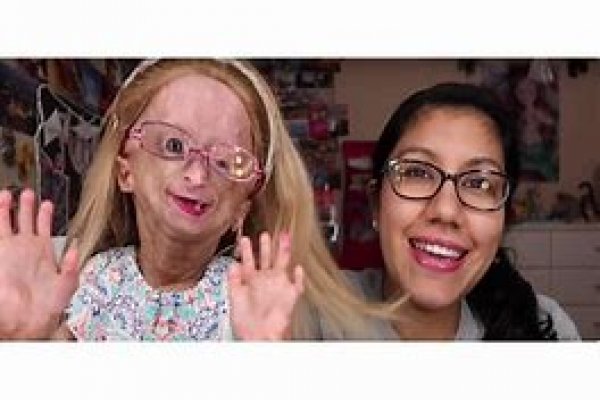 PERÚ Falleció Adalia Rose, la youtuber que padecía la enfermedad que inspiró “El curioso caso de Benjamin Button”