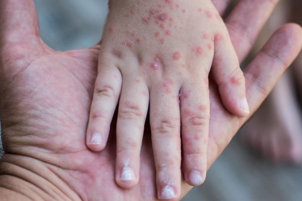 Corrientes: alarma por el virus mano-pie-boca que se propaga en niños y niñas