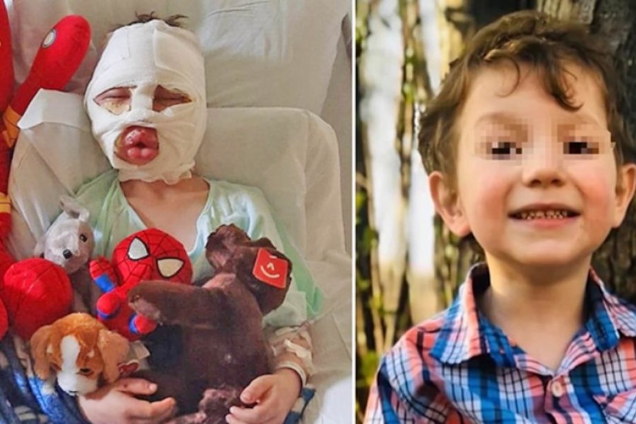 Nene de 6 años sufrió quemaduras tras el ataque de otros chicos con una pelota de tenis en llamas