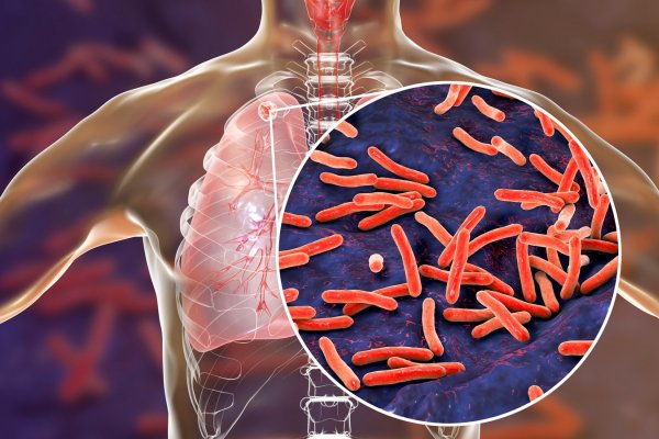 Cuántos casos de tuberculosis hay en Corrientes al año y cómo es el tratamiento