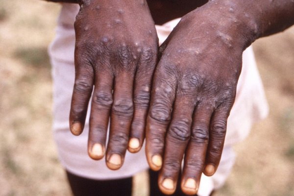 Cientificos africanos desconcertados por como se propagó la enfermedad fuera del continente