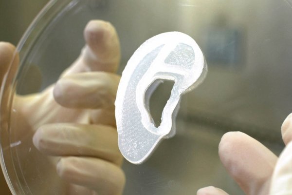 Trasplantan por primera vez una oreja impresa en 3D con células humanas