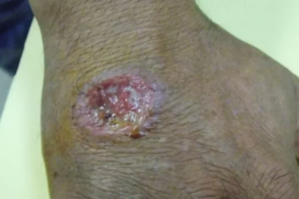 Identificaron zonas de brote de leishmaniasis cutánea en Corrientes