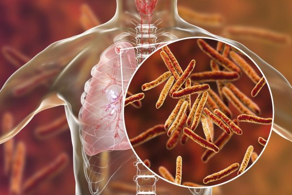 Día Mundial de la tuberculosis: más de 10.000 argentinos padecen una enfermedad prevenible con vacunas