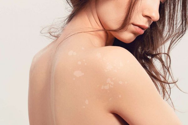 ¿Tienes manchas blancas en la piel? Cinco causas y los mejores consejos para prevenirlas