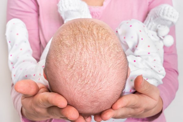 Alopecia en bebés: causas y cuidados