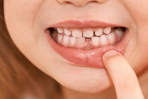 Niños: en qué se diferencian los dientes de leche de los permanentes