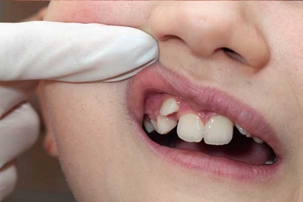 ¿Los dientes de leche torcidos son un problema?