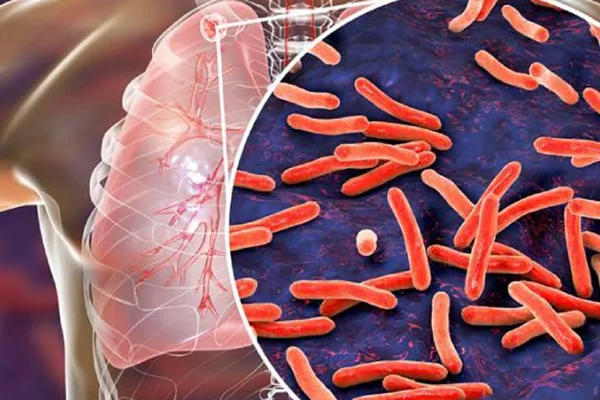 Tuberculosis: Estiman 250 casos por año en Corrientes