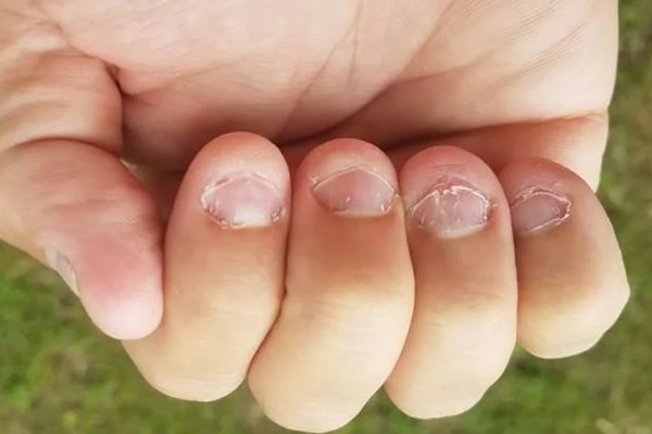 Cómo afecta a la salud tener el hábito de morderse las uñas, según expertos
