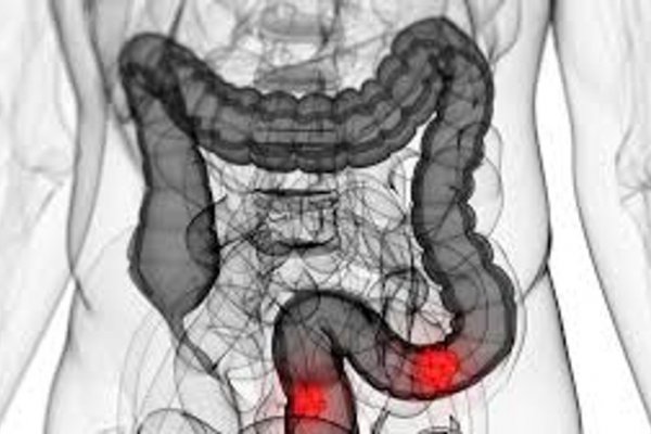 Este es el cambio en un hábito de la alimentación que podés implementar para disminuir el riesgo de cáncer de colon