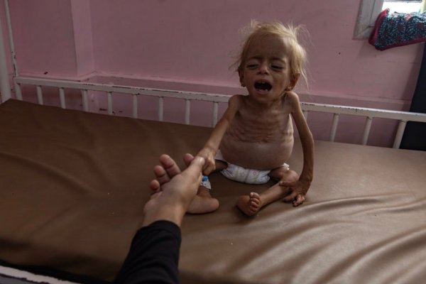 Aumentan a más de 315 los muertos por hambre en Gaza por la ofensiva de Israel, incluidos más de 120 niños